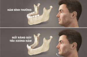 Mất răng dẫn đến tiêu xương hàm