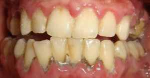 Tình trạng cao răng lâu năm