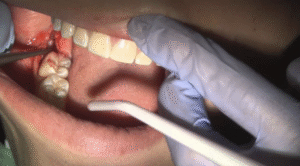 Nhổ răng sai cách gây nhiễm trùng nguy hiểm